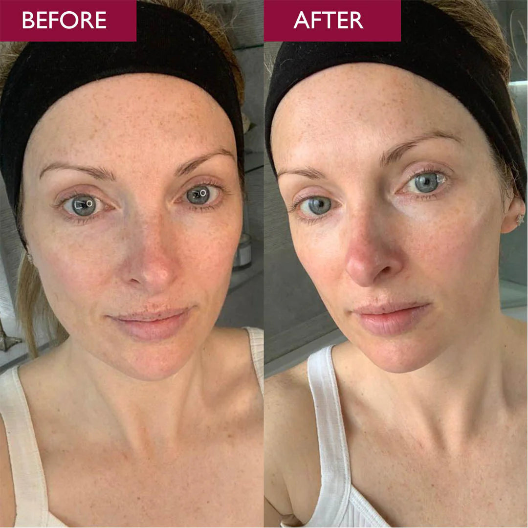 Pro-Radiance Enzyme Peel